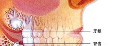 智齿疼痛揭秘：原因、预防与治疗方法全解析