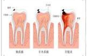 牙疼的深度解析：从生活调养到预防的全面指南