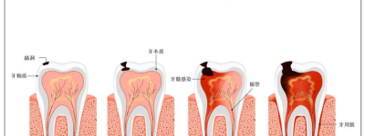 牙疼新解惑专家解析近期流行的牙疼现象