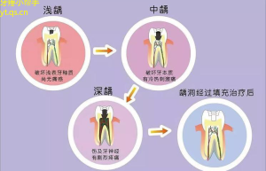 牙疼新知如何避免牙根裂解？